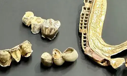 Zahngold und Dentalgold mit Kronen und Brücken zum Ankauf
